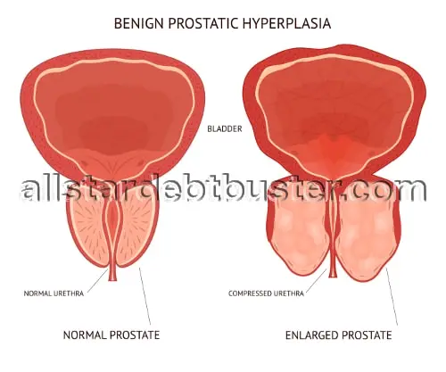 Benign prostatic hyperplasia